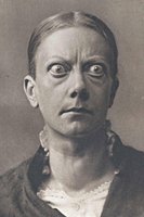 Grave's Disease