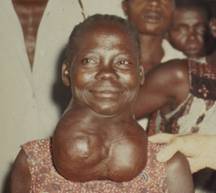 Goiter