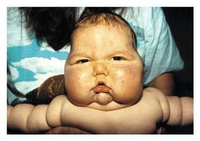 Cushing's Syndrome