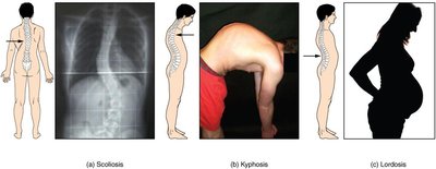 Abnormal Curvatures of Vertebral Column