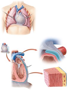 Heart inside the pericardium and layers of the heart wall