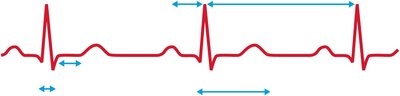 ECG intervals and waves