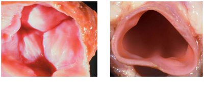 Pulmonary valve, closed and open