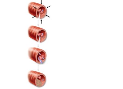 Steps of hemostasis: vascular spasm, platelet plug, coagulation