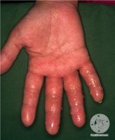 Hand with ICD symptoms