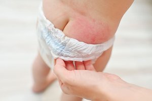 Diaper dermatitis in infant