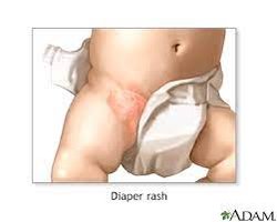 Diaper rash presentation