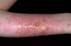 ACD skin presentation