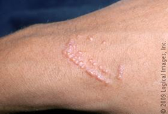 Urushiol-induced ACD presentation