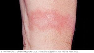 Localized rash from ICD