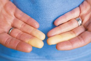 Raynaud’s disease