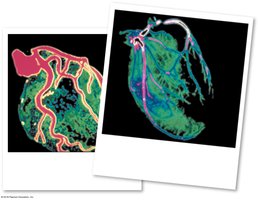 DSA scan showing advanced coronary artery disease