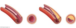 Normal and narrowed artery cross-sections due to atherosclerotic plaque