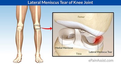 Lateral meniscus tear of knee joint