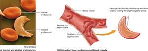 Normal and sickled erythrocytes in sickle cell disease