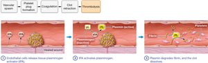 Thrombolysis (clot dissolution)