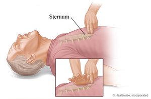 Hand placement for CPR over the sternum