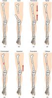 Common types of bone fractures