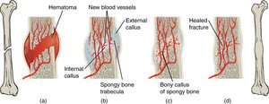 Stages of bone fracture healing