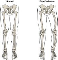 Comparison of normal skeleton and Paget's disease