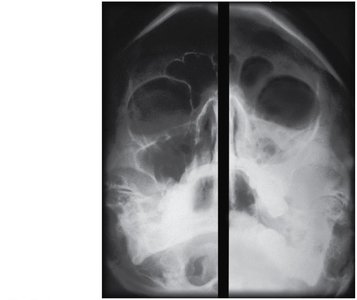 Sinusitis affecting the maxillary sinus