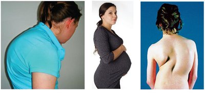 Kyphosis, lordosis, and scoliosis