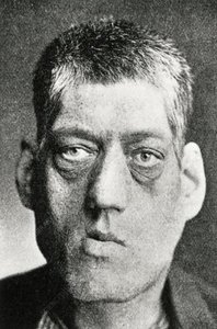 Image illustrating acromegaly