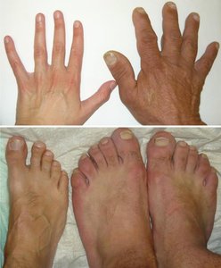 Image showing acromegaly in hands and feet
