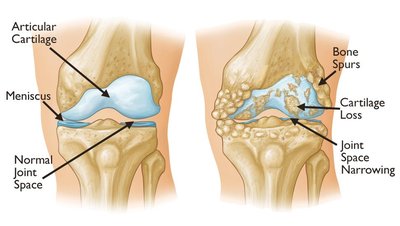 Normal vs osteoarthritic joint anatomy