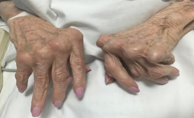 Hands affected by rheumatoid arthritis