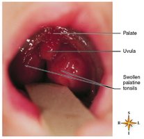 Photograph of swollen palatine tonsils in tonsillitis