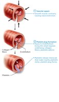 Platelet plug formation: platelets adhere to exposed collagen