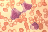 Blood smear showing infectious mononucleosis