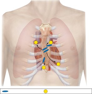 Diagram showing stethoscope placement for heart valve auscultation