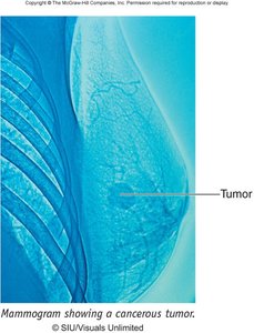 Mammogram showing a cancerous tumor in the breast