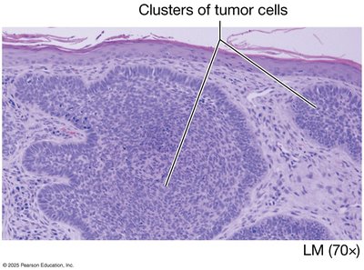 Clusters of tumor cells in carcinoma