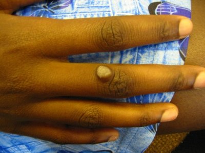 Wart on finger