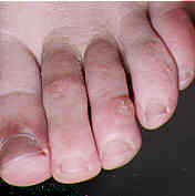 Corns on toes