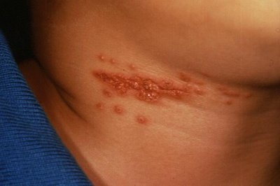 Herpes zoster (shingles) on neck