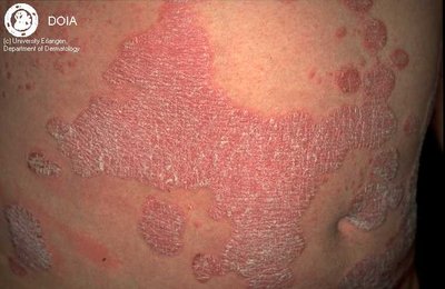 Psoriasis: autoimmune skin disorder