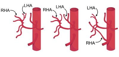Common anatomical variations in blood vessel branching