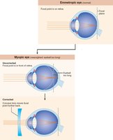 Myopia (nearsightedness)