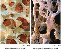 Normal vs. osteoporotic bone structure