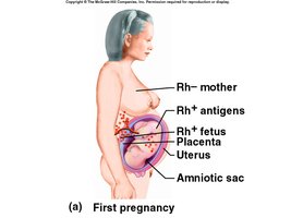 Rh incompatibility in pregnancy