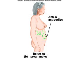 Anti-D antibodies in Rh- mother