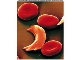 Sickle cell anemia RBCs