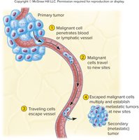 Diagram of metastasis from a primary tumor to secondary sites