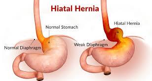 Hiatal hernia diagram