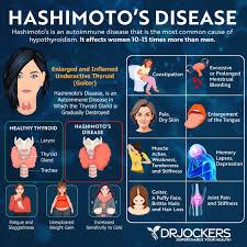 Goiter