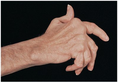 Hand deformed by rheumatoid arthritis